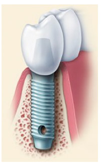 Graphic showing how tooth is implated.