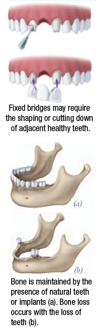 Graphic showing how dentures may lead to bone loss in the jaw.