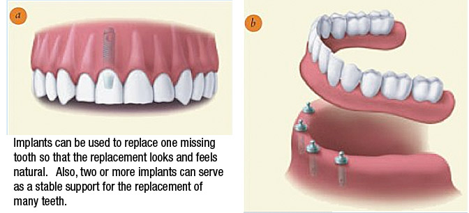 Multi Graphic showing how implants can replace one or many missing teeth.