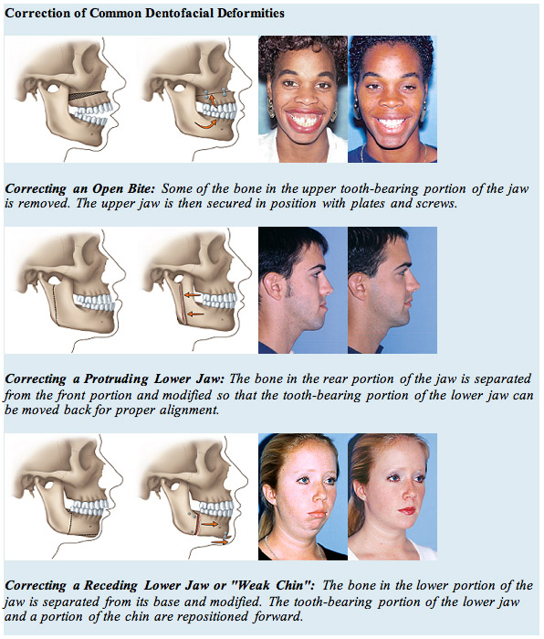 Images and Graphics showing 3 cases of Correction of Common Dentofacial Deformities