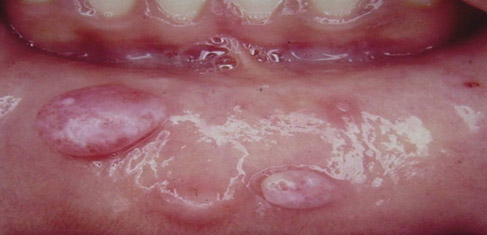 Photographic image showing tumors in the mouth