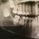 Photographic image showing an x-ray of a mouth with tumors