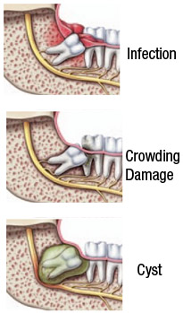 Graphic showing the dangers of not removing wisdom teeth