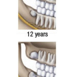 Graphic showing how unremoved impacted widom might look at 12 and 14 years
