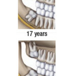 Graphic showing how unremoved impacted widom might look at 17 and 25 years